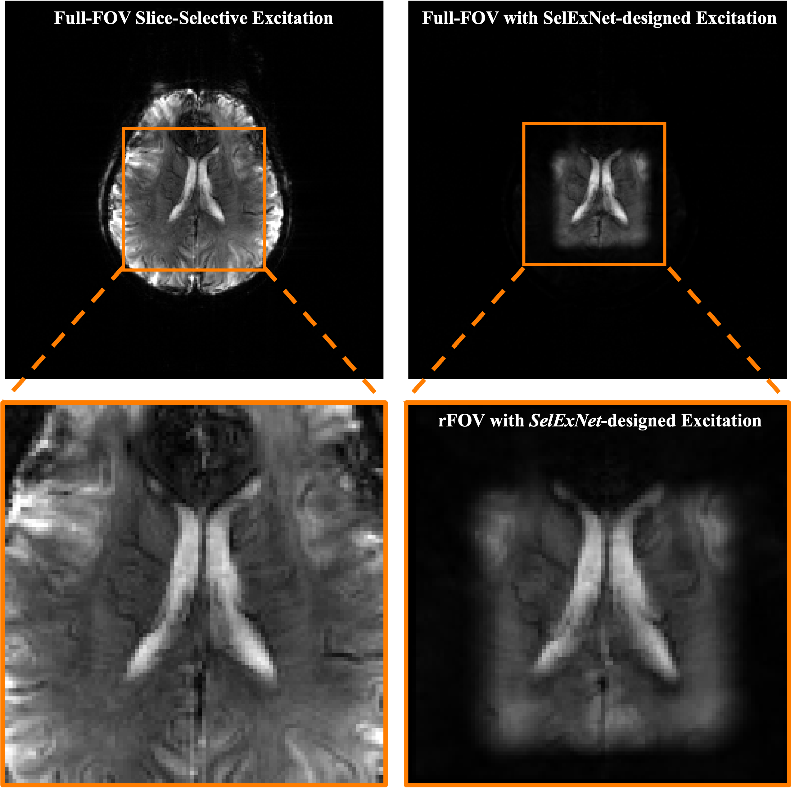 In-vivo pTx reduced field-of-view MRI with SelExNet-designed excitation